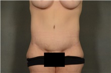 Tummy Tuck After Photo by Ellen Janetzke, MD; Bloomfield Hills, MI - Case 40911