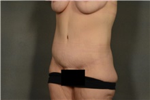 Tummy Tuck After Photo by Ellen Janetzke, MD; Bloomfield Hills, MI - Case 40911