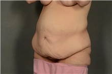 Tummy Tuck Before Photo by Ellen Janetzke, MD; Bloomfield Hills, MI - Case 40911