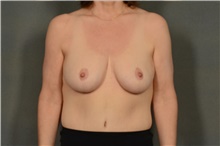Breast Augmentation After Photo by Ellen Janetzke, MD; Bloomfield Hills, MI - Case 40912