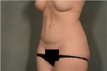 Tummy Tuck After Photo by Ellen Janetzke, MD; Bloomfield Hills, MI - Case 40913