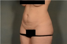 Tummy Tuck Before Photo by Ellen Janetzke, MD; Bloomfield Hills, MI - Case 40913