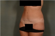 Tummy Tuck After Photo by Ellen Janetzke, MD; Bloomfield Hills, MI - Case 40914