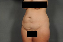 Tummy Tuck Before Photo by Ellen Janetzke, MD; Bloomfield Hills, MI - Case 40914