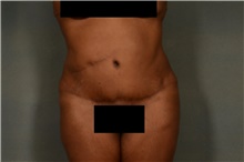 Tummy Tuck After Photo by Ellen Janetzke, MD; Bloomfield Hills, MI - Case 40915