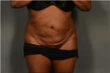 Tummy Tuck Before Photo by Ellen Janetzke, MD; Bloomfield Hills, MI - Case 40915