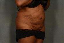 Tummy Tuck Before Photo by Ellen Janetzke, MD; Bloomfield Hills, MI - Case 40915