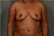 Breast Reduction After Photo by Ellen Janetzke, MD; Bloomfield Hills, MI - Case 40916