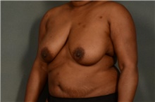 Breast Reduction Before Photo by Ellen Janetzke, MD; Bloomfield Hills, MI - Case 40916