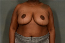Breast Reduction After Photo by Ellen Janetzke, MD; Bloomfield Hills, MI - Case 40917