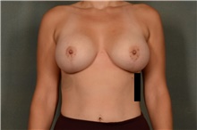 Breast Augmentation After Photo by Ellen Janetzke, MD; Bloomfield Hills, MI - Case 41287