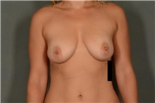 Breast Augmentation Before Photo by Ellen Janetzke, MD; Bloomfield Hills, MI - Case 41287