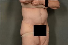 Tummy Tuck After Photo by Ellen Janetzke, MD; Bloomfield Hills, MI - Case 41300