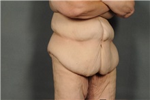 Tummy Tuck Before Photo by Ellen Janetzke, MD; Bloomfield Hills, MI - Case 41300