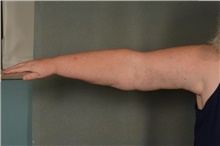 Arm Lift After Photo by Ellen Janetzke, MD; Bloomfield Hills, MI - Case 41366