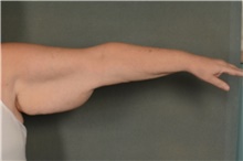 Arm Lift Before Photo by Ellen Janetzke, MD; Bloomfield Hills, MI - Case 41366