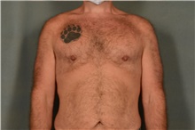 Male Breast Reduction After Photo by Ellen Janetzke, MD; Bloomfield Hills, MI - Case 41371