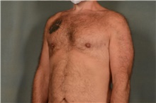Male Breast Reduction After Photo by Ellen Janetzke, MD; Bloomfield Hills, MI - Case 41371