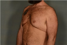 Male Breast Reduction Before Photo by Ellen Janetzke, MD; Bloomfield Hills, MI - Case 41371