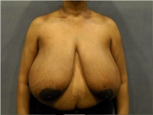 Breast Reduction Before Photo by Ellen Janetzke, MD; Bloomfield Hills, MI - Case 41489