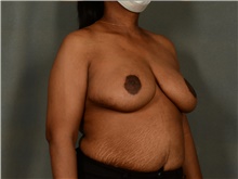 Breast Reduction After Photo by Ellen Janetzke, MD; Bloomfield Hills, MI - Case 41489