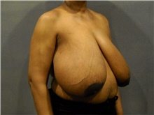 Breast Reduction Before Photo by Ellen Janetzke, MD; Bloomfield Hills, MI - Case 41489