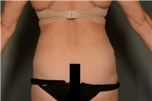 Liposuction After Photo by Ellen Janetzke, MD; Bloomfield Hills, MI - Case 41665