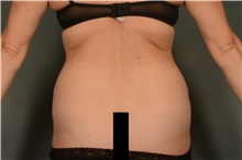 Liposuction Before Photo by Ellen Janetzke, MD; Bloomfield Hills, MI - Case 41665