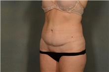 Tummy Tuck After Photo by Ellen Janetzke, MD; Bloomfield Hills, MI - Case 41666