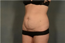 Tummy Tuck Before Photo by Ellen Janetzke, MD; Bloomfield Hills, MI - Case 41666