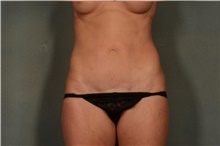 Tummy Tuck After Photo by Ellen Janetzke, MD; Bloomfield Hills, MI - Case 41667