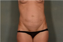 Tummy Tuck Before Photo by Ellen Janetzke, MD; Bloomfield Hills, MI - Case 41667