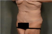 Tummy Tuck After Photo by Ellen Janetzke, MD; Bloomfield Hills, MI - Case 41668