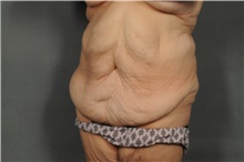 Tummy Tuck Before Photo by Ellen Janetzke, MD; Bloomfield Hills, MI - Case 41668