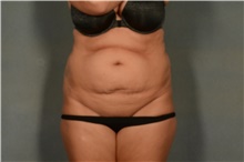 Tummy Tuck Before Photo by Ellen Janetzke, MD; Bloomfield Hills, MI - Case 42260