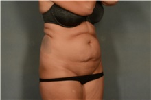 Tummy Tuck Before Photo by Ellen Janetzke, MD; Bloomfield Hills, MI - Case 42260