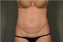 Tummy Tuck Before Photo by Ellen Janetzke, MD; Bloomfield Hills, MI - Case 42261