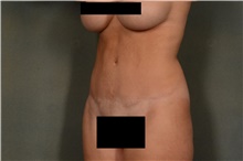 Tummy Tuck After Photo by Ellen Janetzke, MD; Bloomfield Hills, MI - Case 42261