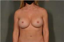 Breast Augmentation After Photo by Ellen Janetzke, MD; Bloomfield Hills, MI - Case 42262