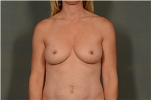 Breast Augmentation Before Photo by Ellen Janetzke, MD; Bloomfield Hills, MI - Case 42262
