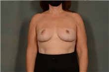 Breast Reduction After Photo by Ellen Janetzke, MD; Bloomfield Hills, MI - Case 42264