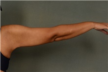 Arm Lift After Photo by Ellen Janetzke, MD; Bloomfield Hills, MI - Case 42771