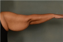 Arm Lift Before Photo by Ellen Janetzke, MD; Bloomfield Hills, MI - Case 42771