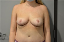 Breast Reduction After Photo by Ellen Janetzke, MD; Bloomfield Hills, MI - Case 42772
