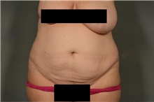 Tummy Tuck Before Photo by Ellen Janetzke, MD; Bloomfield Hills, MI - Case 42773