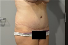 Tummy Tuck After Photo by Ellen Janetzke, MD; Bloomfield Hills, MI - Case 42773