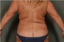 Liposuction After Photo by Ellen Janetzke, MD; Bloomfield Hills, MI - Case 42774