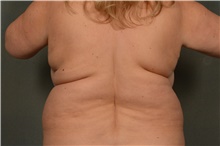 Liposuction Before Photo by Ellen Janetzke, MD; Bloomfield Hills, MI - Case 42774