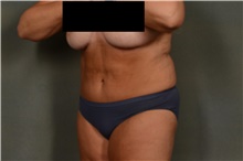 Tummy Tuck After Photo by Ellen Janetzke, MD; Bloomfield Hills, MI - Case 42775