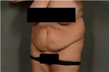 Tummy Tuck Before Photo by Ellen Janetzke, MD; Bloomfield Hills, MI - Case 42775
